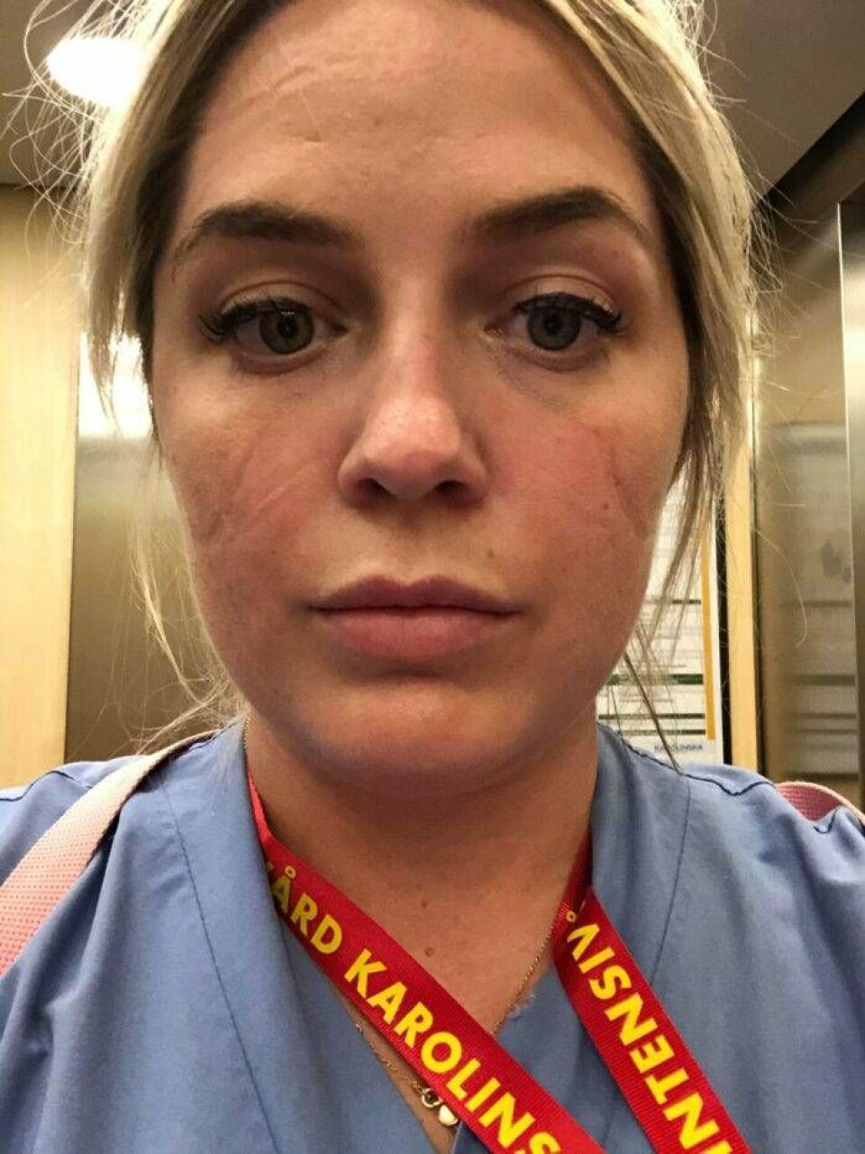 Specialistsjuksköterskan Matilda Nygren berättar att hon får skavmärken i ansiktet av skyddsutrustningen hon har på sig i salen där de sjukaste covid-19-patienterna ligger. Specialistsjuksköterskan Matilda Nygren berättar att hon får skavmärken i ansiktet av skyddsutrustningen hon har på sig i salen där de sjukaste covid-19-patienterna ligger.